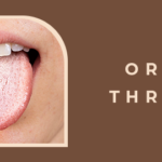 Understanding Oral Thrush: Causes, Symptoms, and Treatment Options