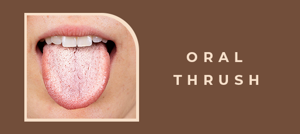 Understanding Oral Thrush: Causes, Symptoms, and Treatment Options