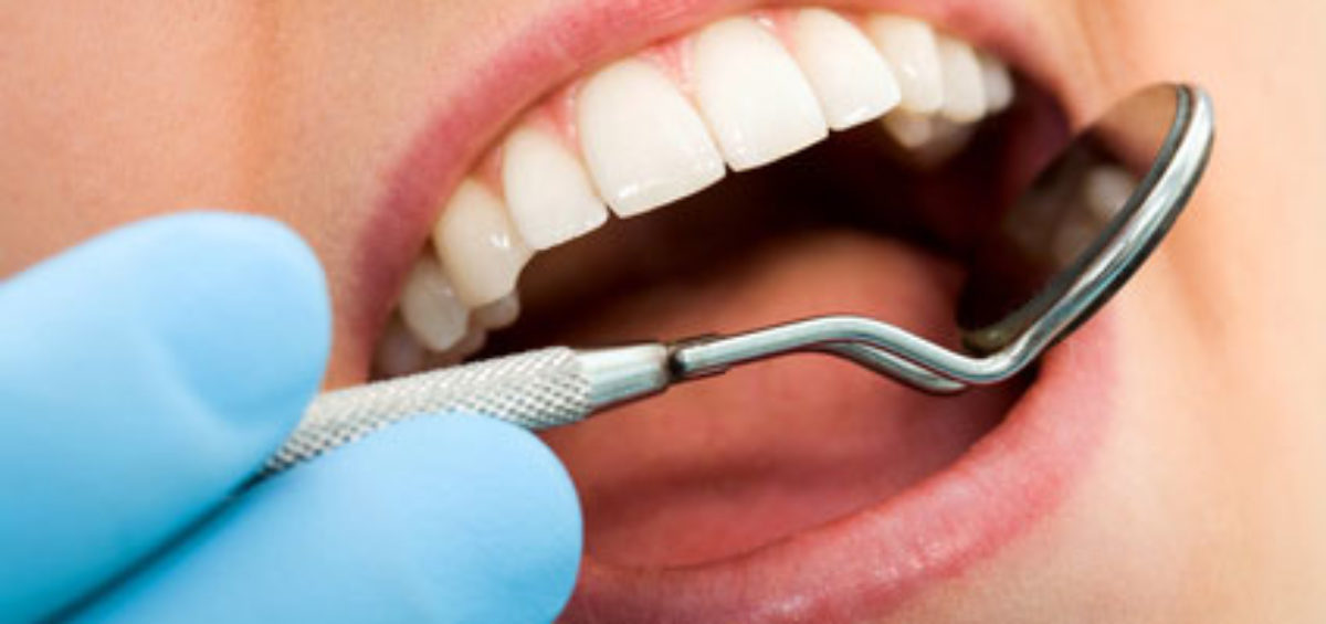 The Benefits of Replacing Amalgam Fillings with Composite Fillings