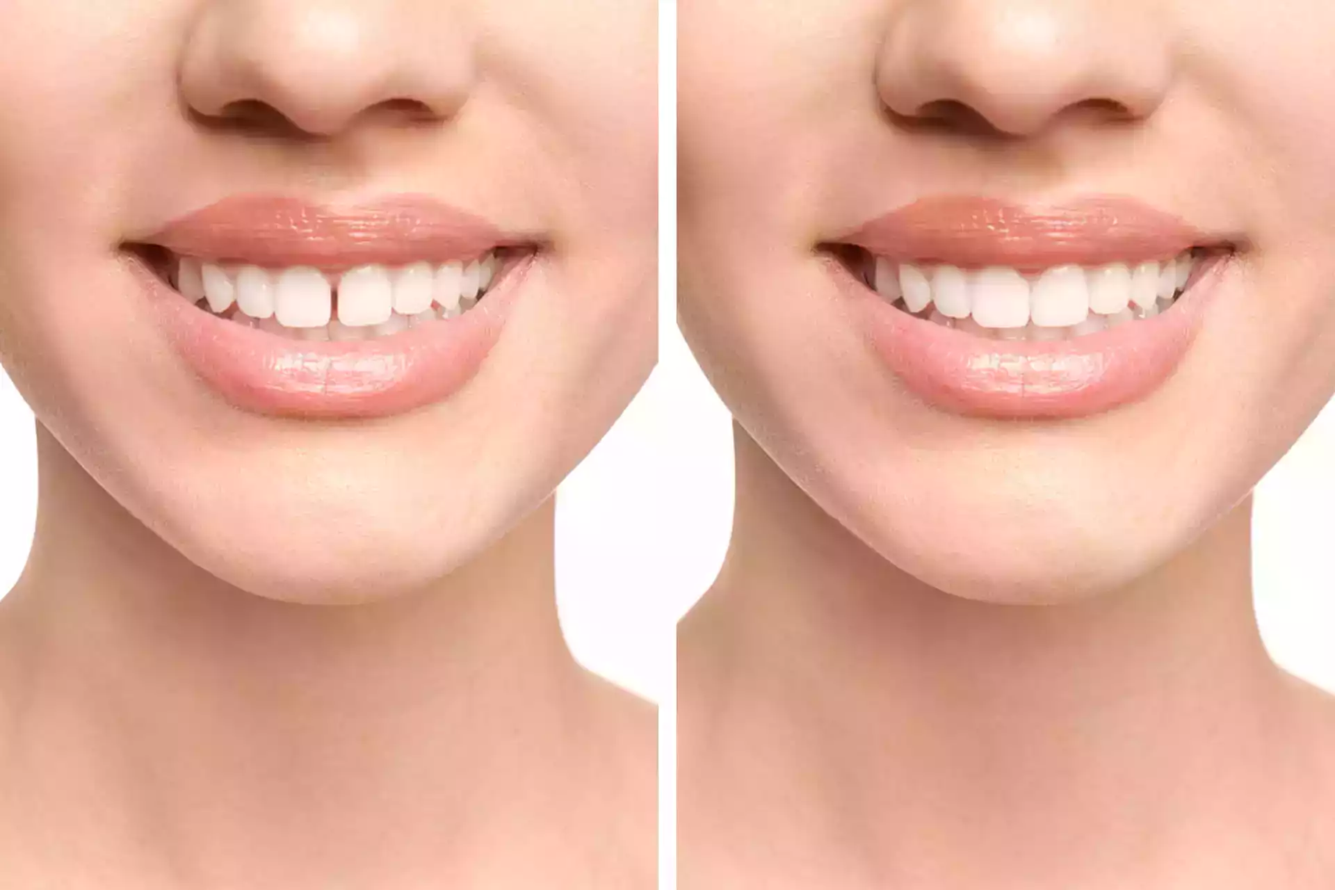 What Causes Diastema and How to Repair Teeth Gaps